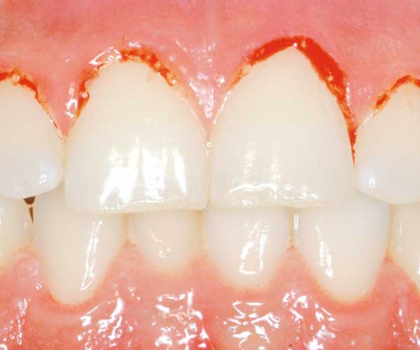 Tandköttsinflammation - paradontit, granatäpple har antiinflammatoriska och antibakteriella egenskaper och kan skydda.